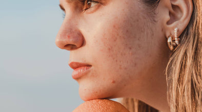 Clear Skin, Clear Confidence: Top 10 Acne-Fighting Tips!